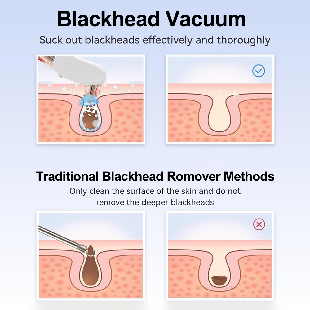 Elektrikli Siyah Nokta Remover - Pore Vacuum incelemesi ve fiyatı